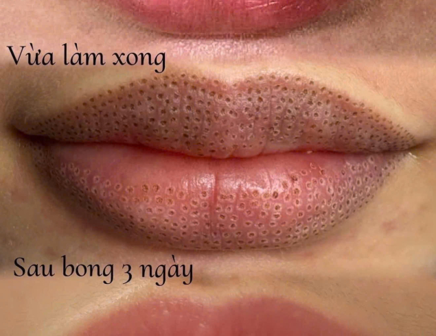 XOÁ - SỬA MÔI